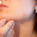 acne treatmente